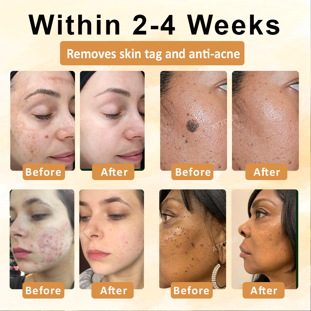 ATTDX® CastorBee Tag & Spots Peel-Off Mask