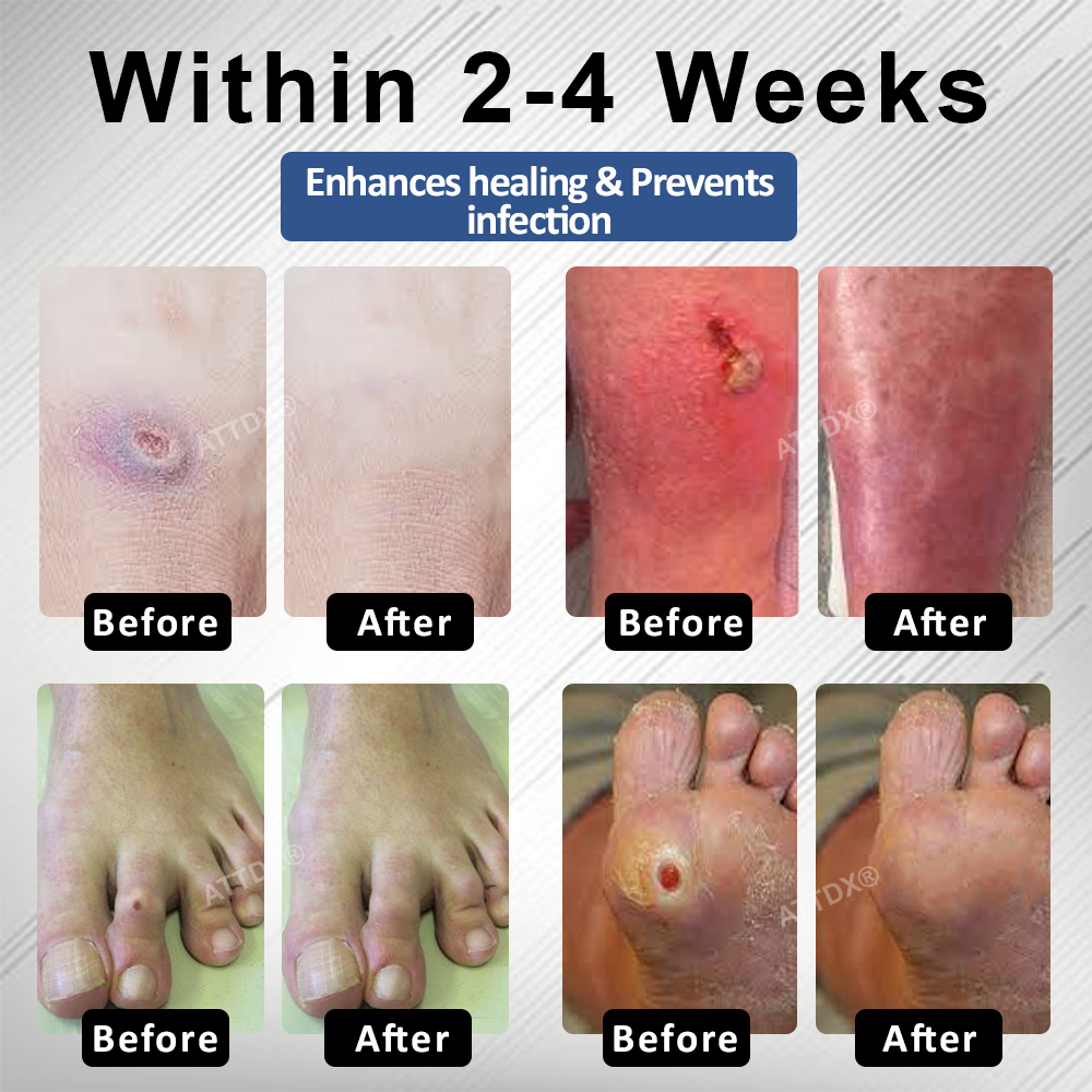 ATTDX® Diabetes Foot Guard Fast Recovery Spray