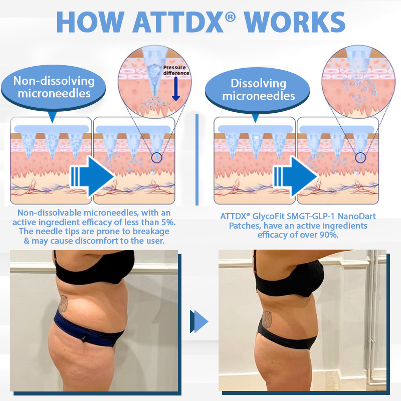 ATTDX® GlycoFit SMGT-GLP-1 NanoDart Patches