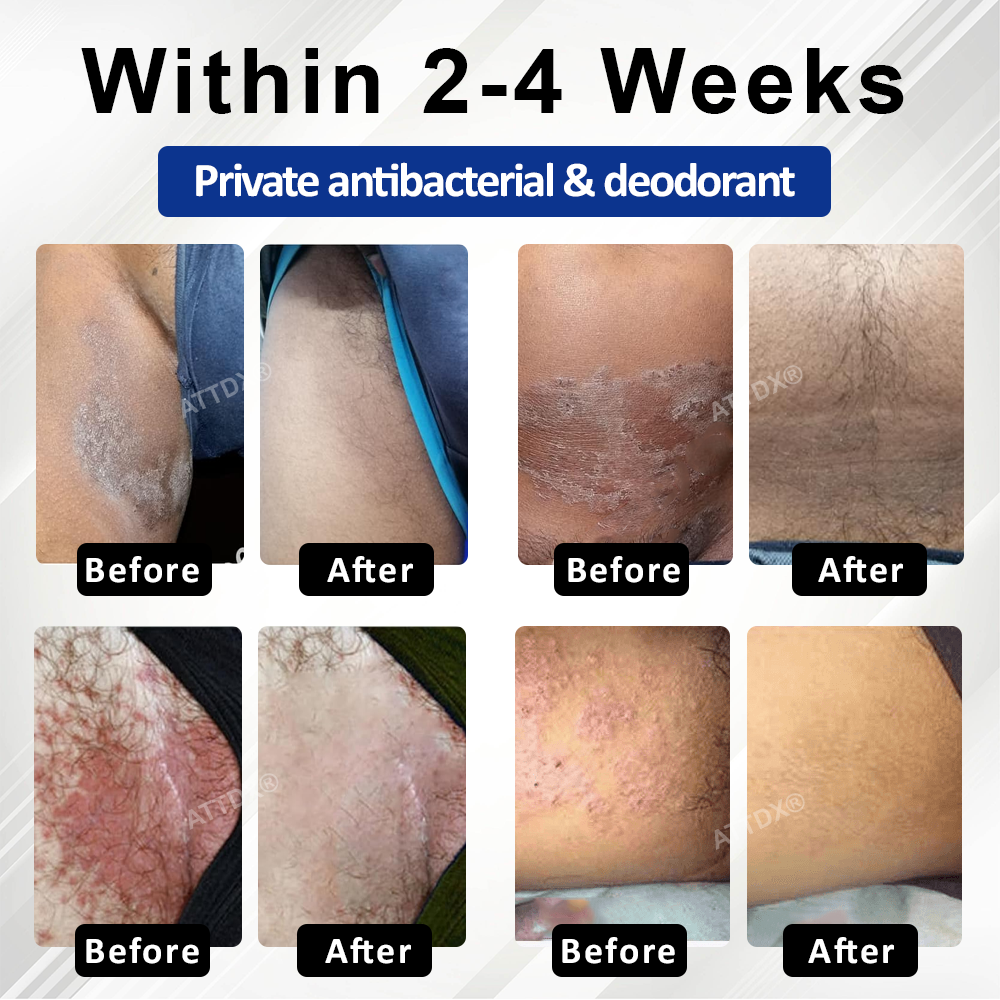 ATTDX® LicorRelief Man Genital Antifungal Cream
