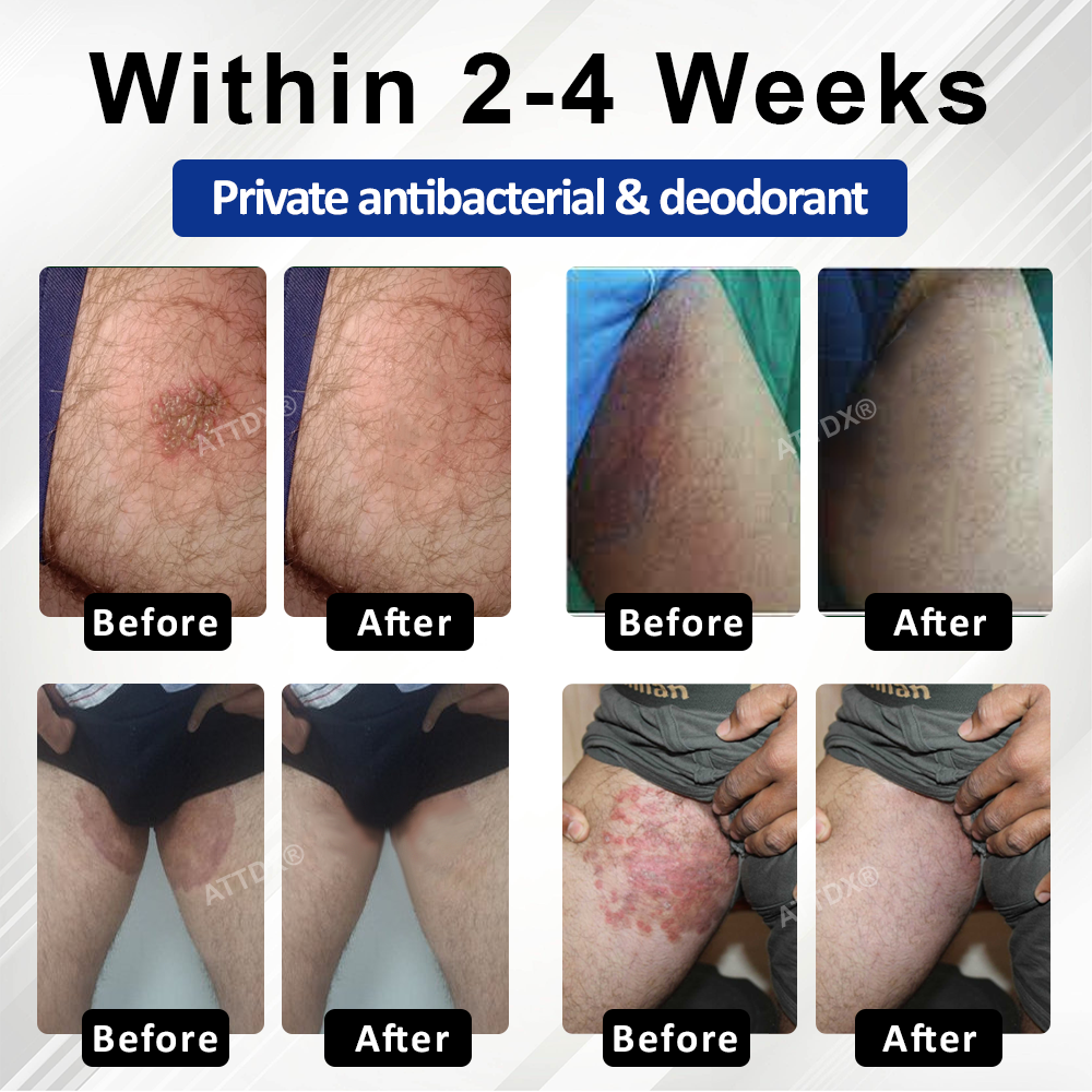 ATTDX® LicorRelief Man Genital Antifungal Cream
