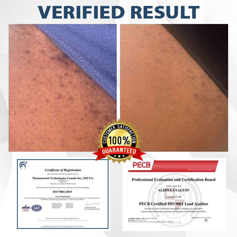 ATTDX® HPV Genital Warts Relief Cream 2