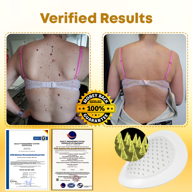 MoleClear Microneedle BeeVenom Patch