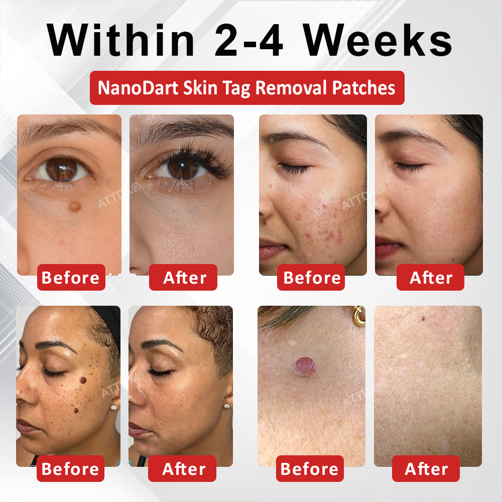 ATTDX® NanoDart Skin Tag Removal Patches