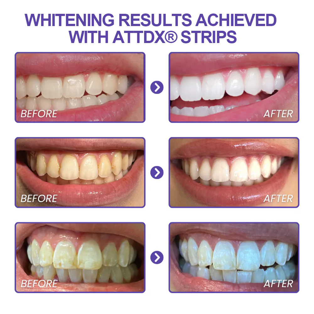 ATTDX® Purple Whitening Teeth Strips