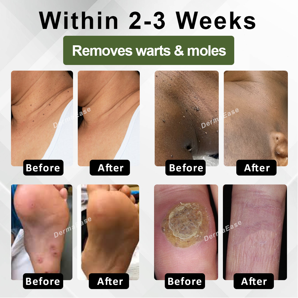 DermaEase™ Spotless Tag and WartRemoval Gel
