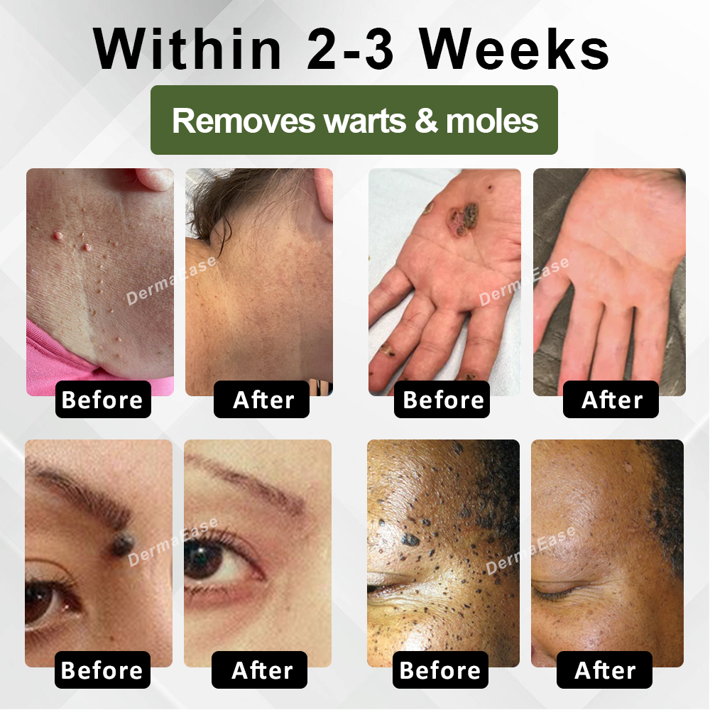 DermaEase™ Spotless Tag and WartRemoval Gel