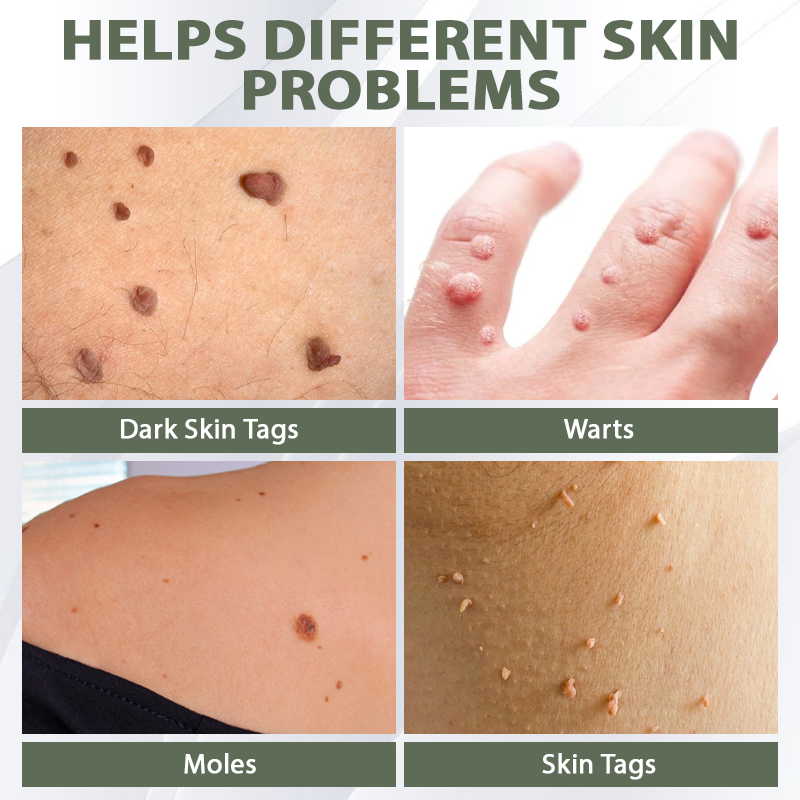 DermaEase™ Spotless Tag and WartRemoval Gel