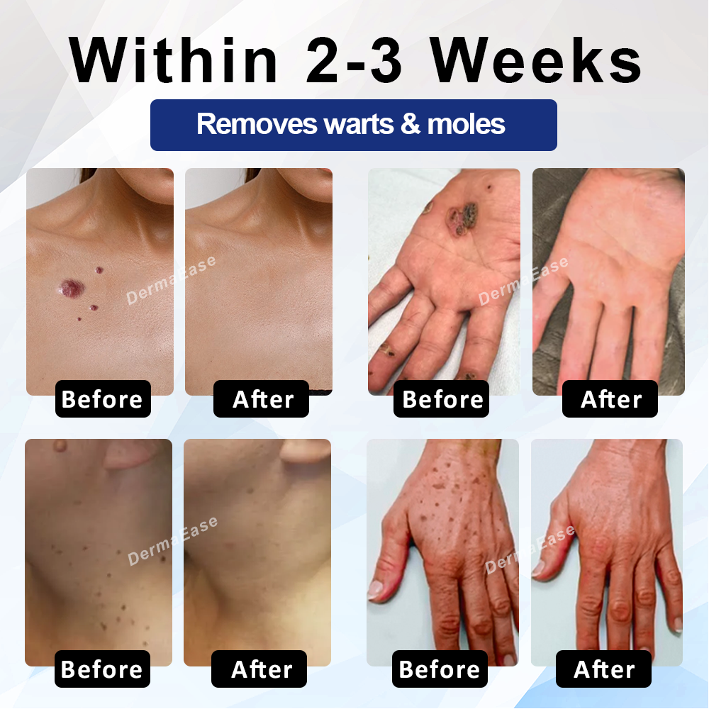 ATTDX® DermaSoft Tag & Mole Clear Gel