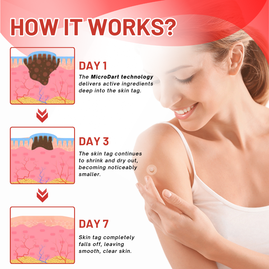 DermaEase™ MicroDart Skin Tag Remover Patch