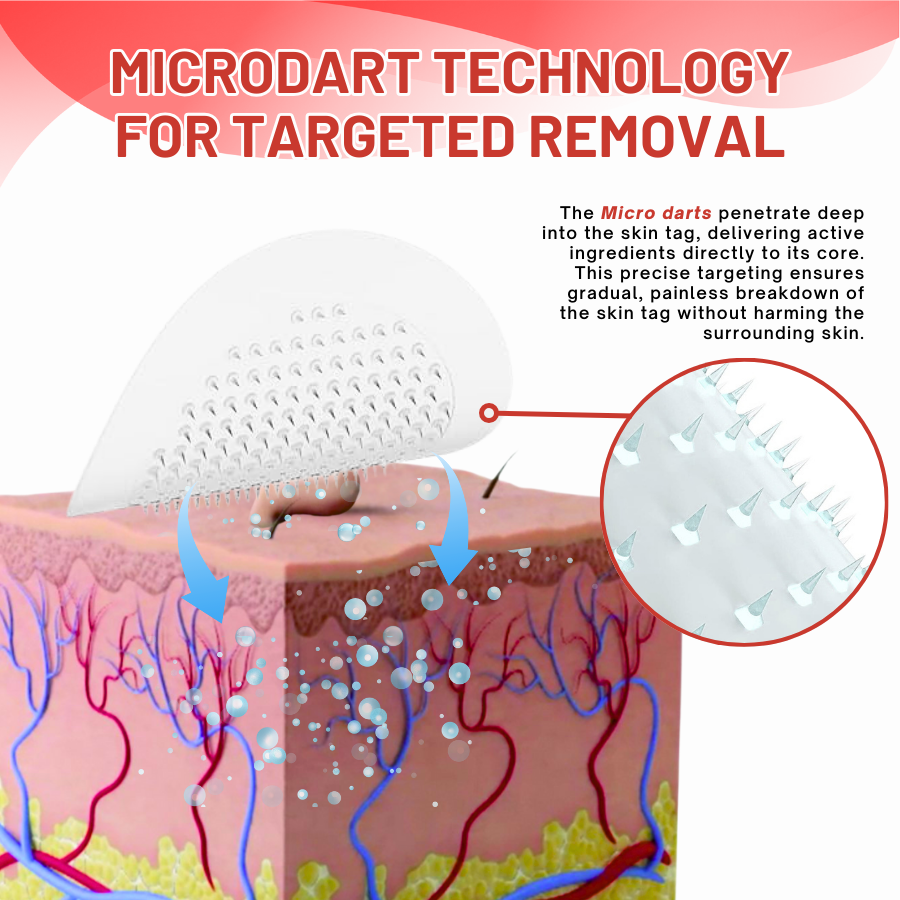 DermaEase™ MicroDart Skin Tag Remover Patch