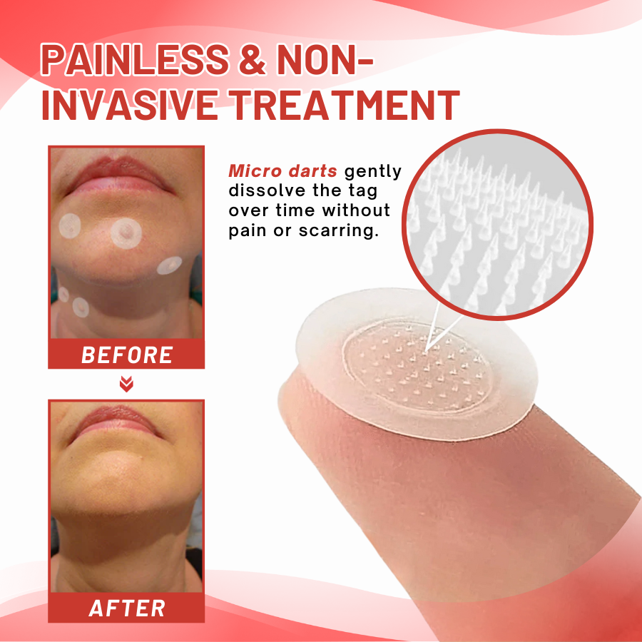 DermaEase™ MicroDart Skin Tag Remover Patch