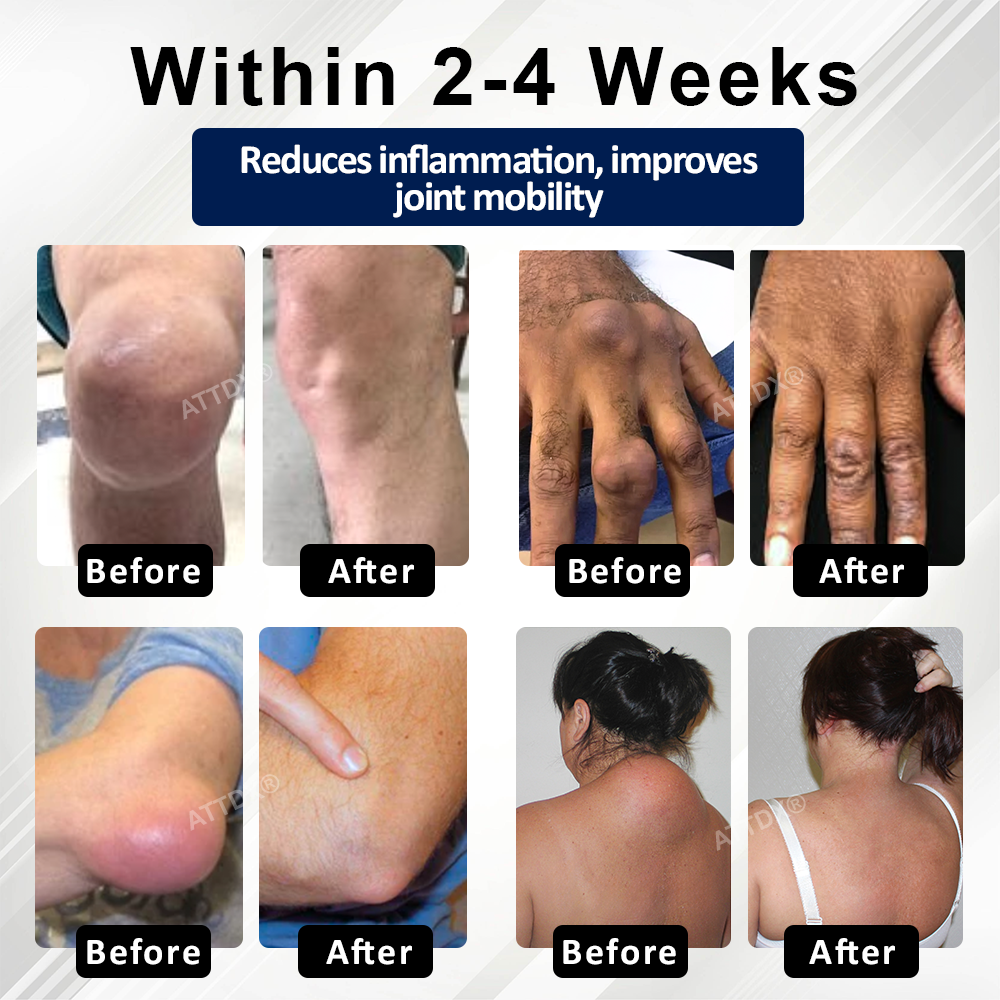 ATTDX® BeeEase MicroSting Joint Patches