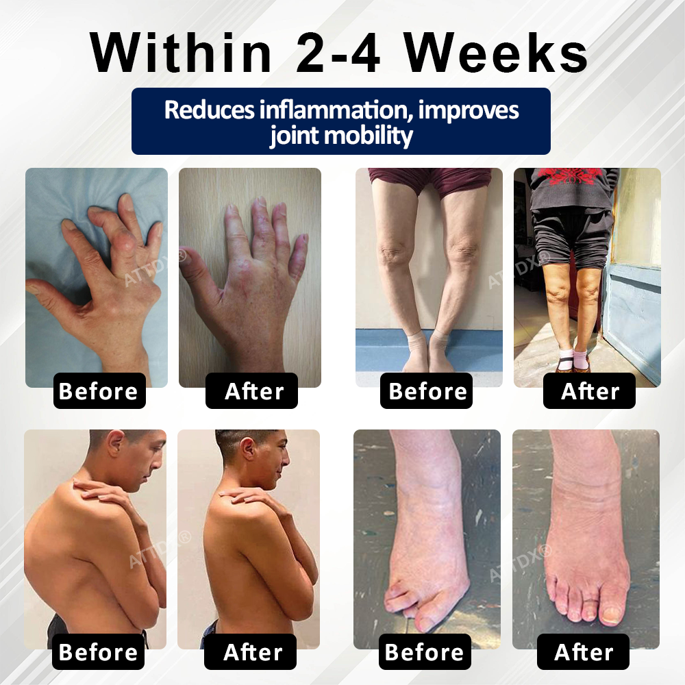 ATTDX® BeeEase MicroSting Joint Patches