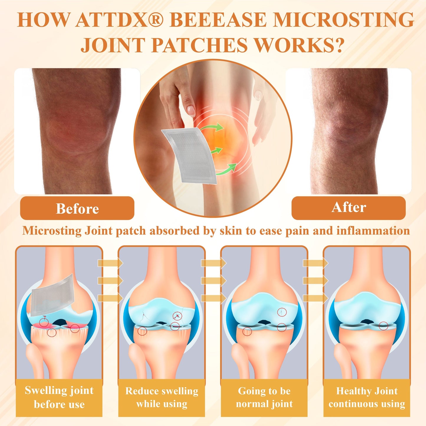 ATTDX® BeeEase MicroSting Joint Patches