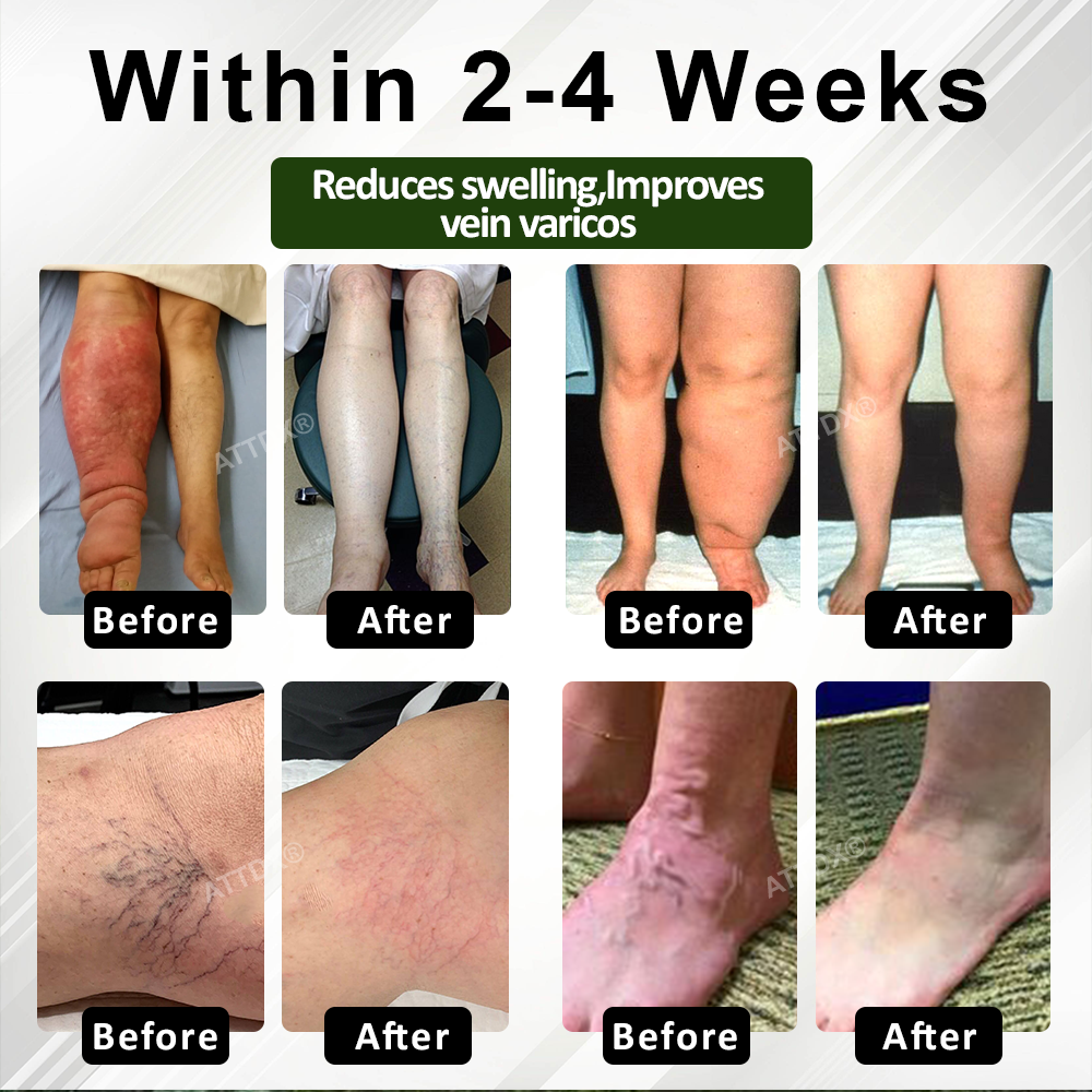 ATTDX® CircuHerb Edema Soothing & Healing Balm 2