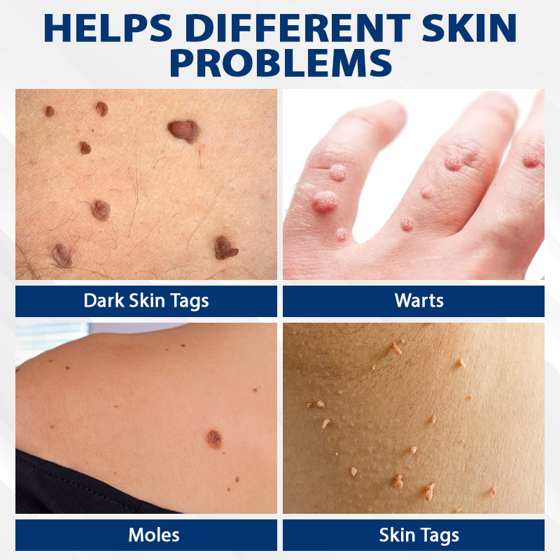 ATTDX® DermaSoft Tag & Mole Clear Gel