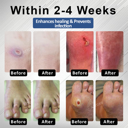 ATTDX® Diabetes Foot Guard Fast Recovery Spray