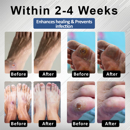 ATTDX® Diabetes Foot Guard Fast Recovery Spray