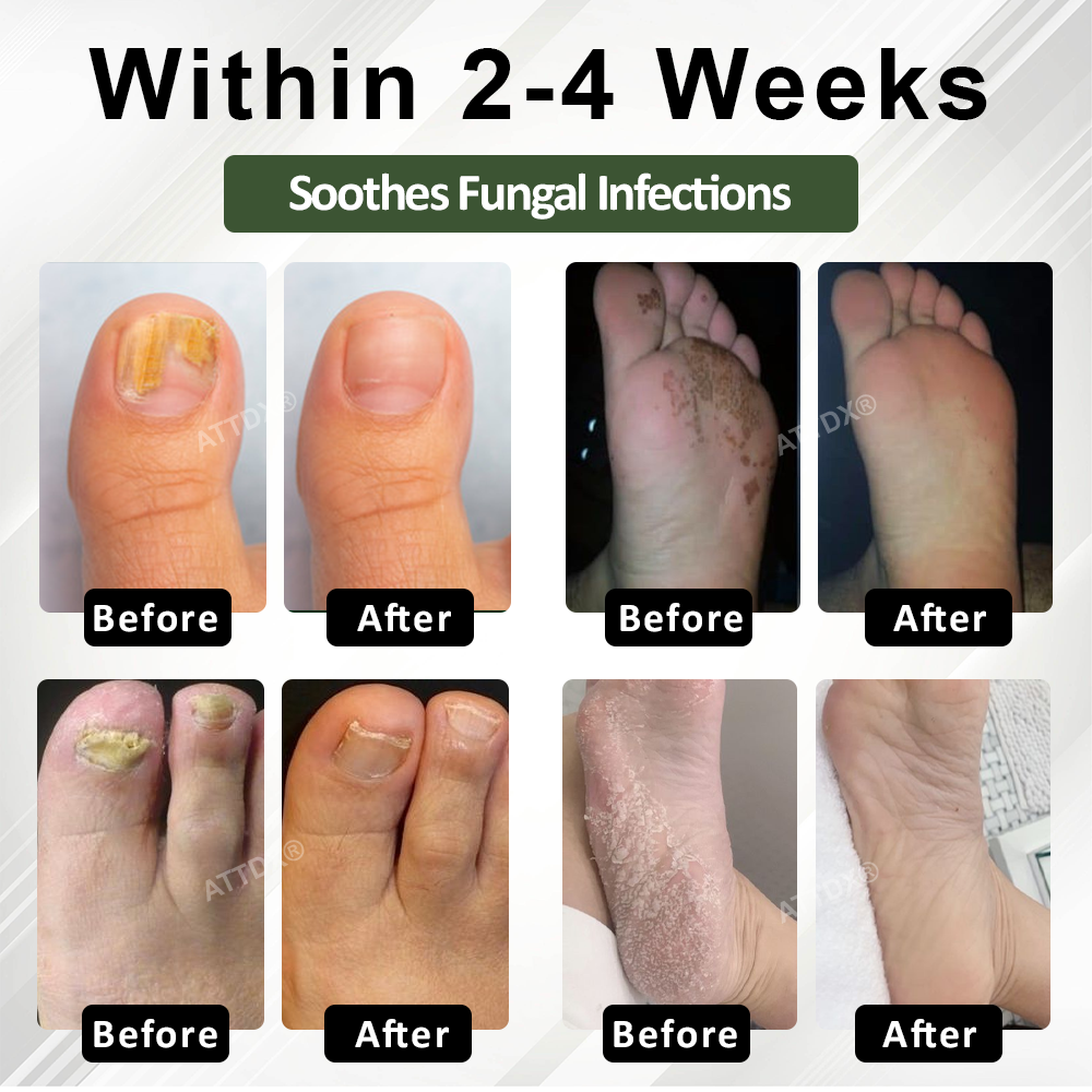 ATTDX® FungaGuard Nail Renewal Herbal Spray