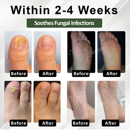 ATTDX® FungaGuard Nail Renewal Herbal Spray
