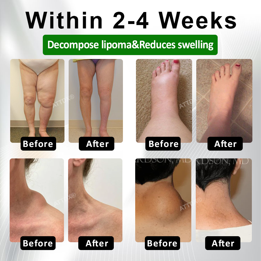 ATTDX® LipoClear Sparganium Rhizome Relief Cream