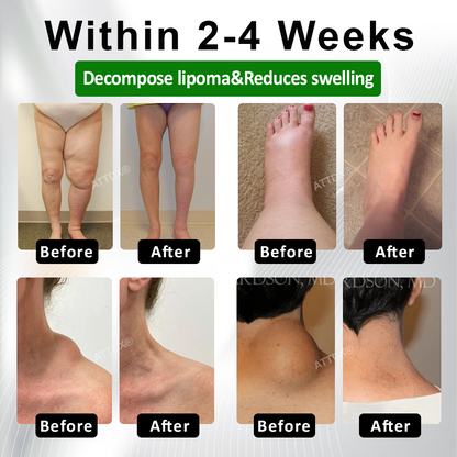 ATTDX® LipoClear Sparganium Rhizome Relief Cream