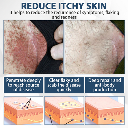 ATTDX® ManGuard HPV Wart Healing Cream