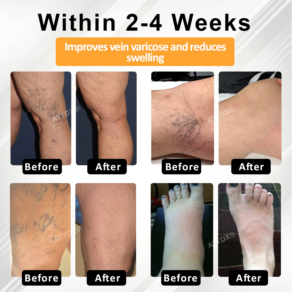 ATTDX® MicroSting Bee Vein Ease Patches