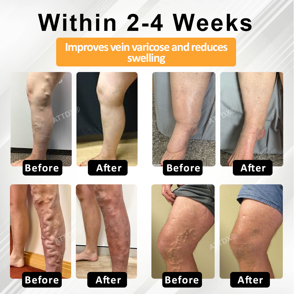 ATTDX® MicroSting Bee Vein Ease Patches