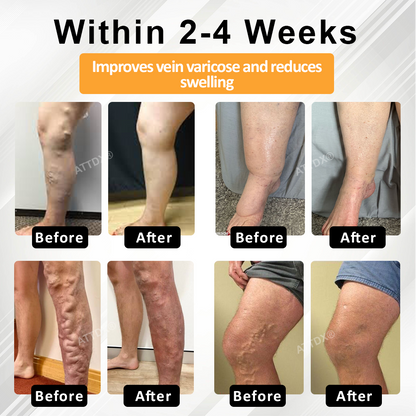 ATTDX® MicroSting Bee Vein Ease Patches
