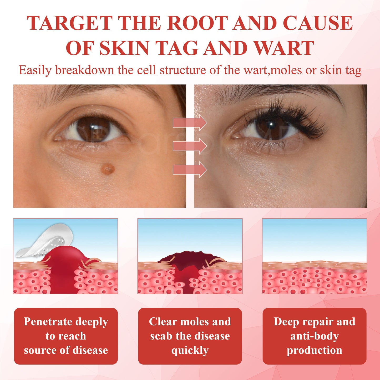 ATTDX® NanoDart Skin Tag Removal Patches