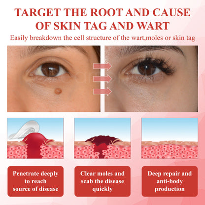 ATTDX® NanoDart Skin Tag Removal Patches