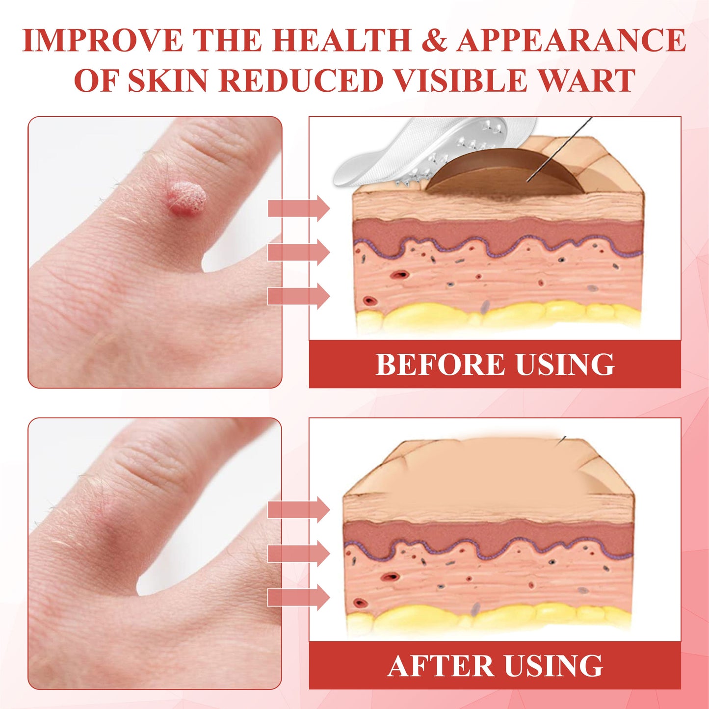 ATTDX® NanoDart Skin Tag Removal Patches
