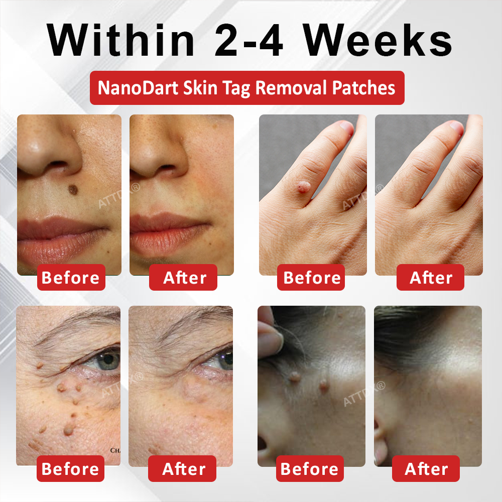 ATTDX® NanoDart Skin Tag Removal Patches