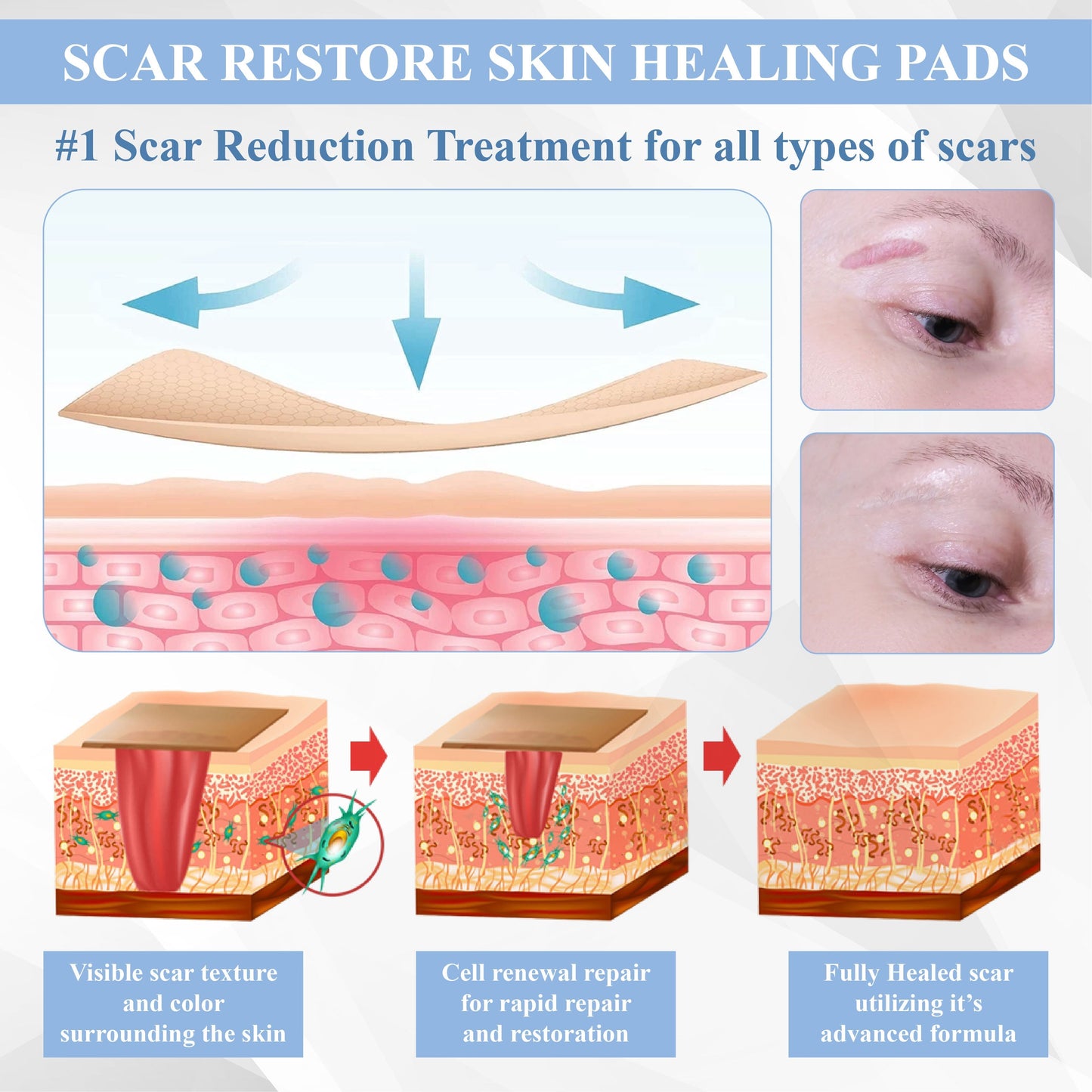 ATTDX® ScarRepair EGF Nanodart Patches