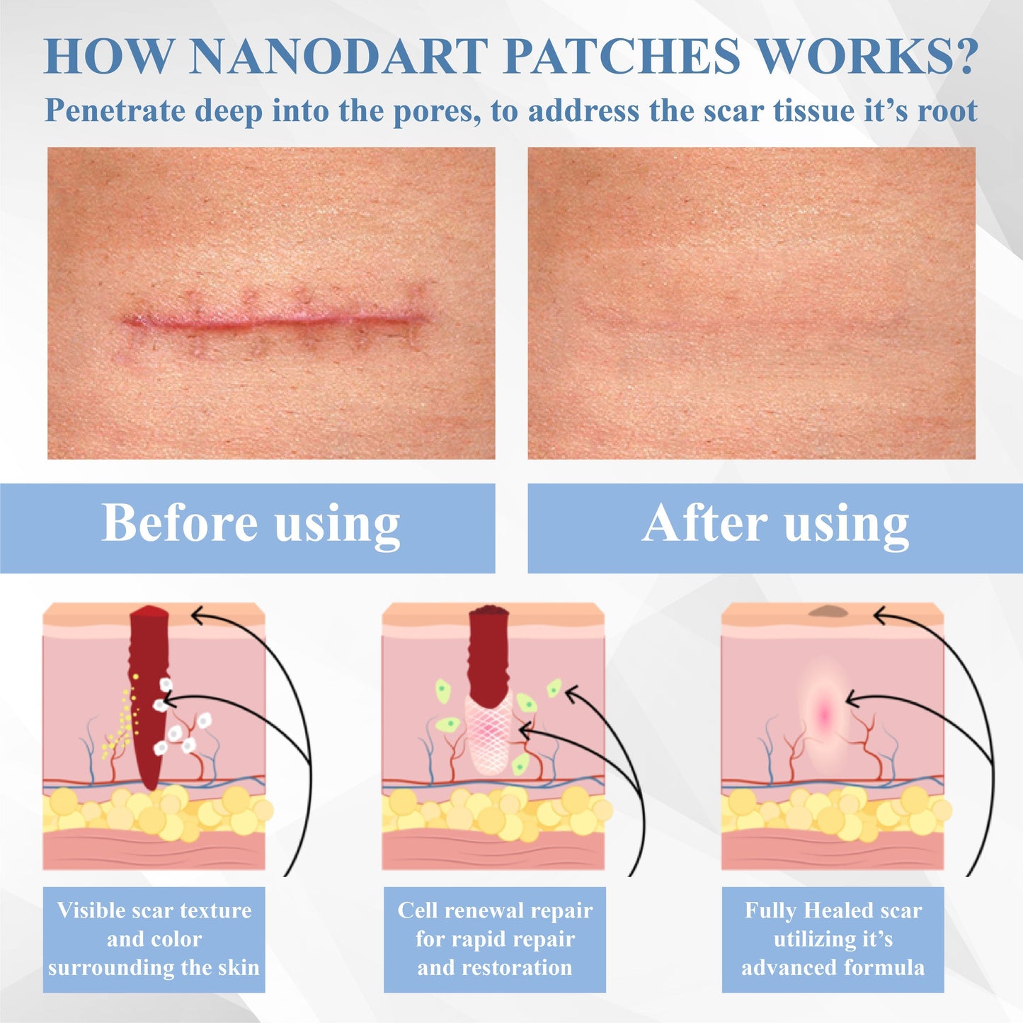 ATTDX® ScarRepair EGF Nanodart Patches