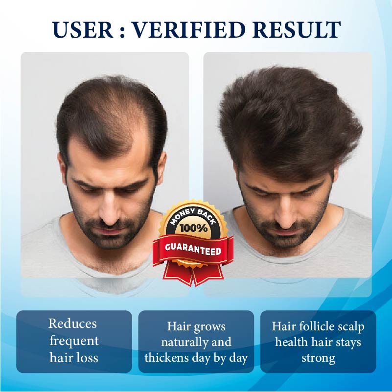 ThickBoost Herbal HairGrowth Serum for Men 2