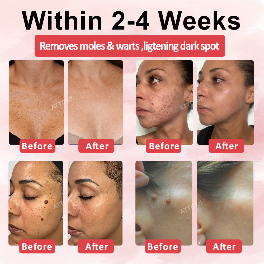 ATTDX® Wart & Spot Erase Advanced Particle Serum