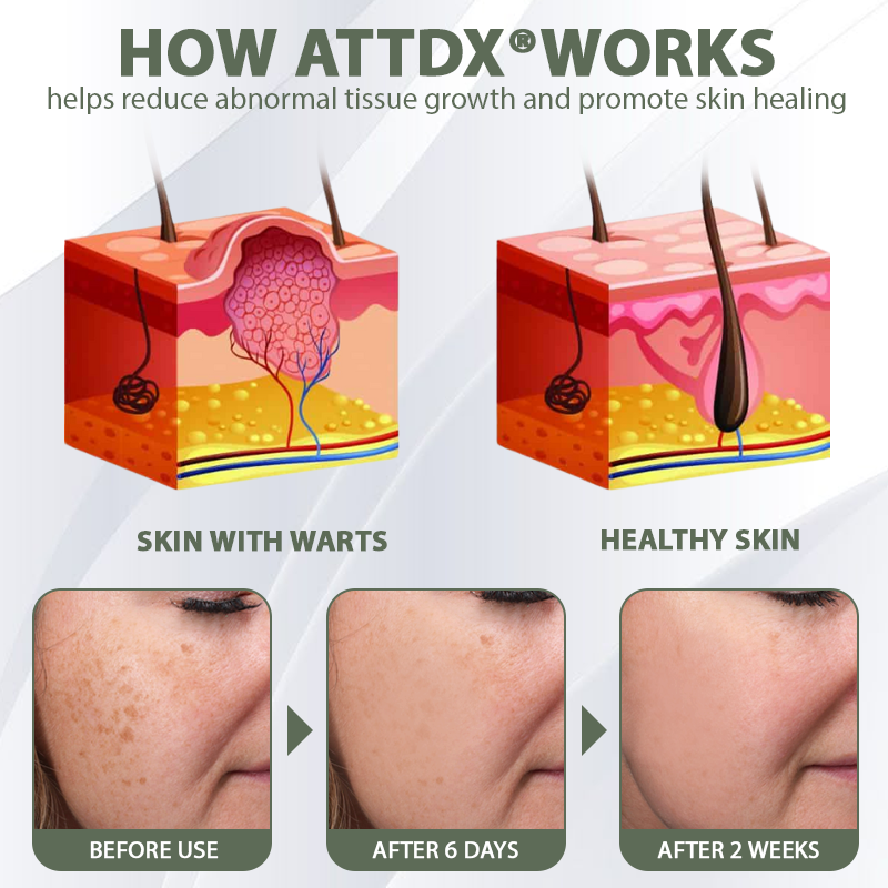 ATTDX® Tea Tree Focused WartAway MicroDart Patch
