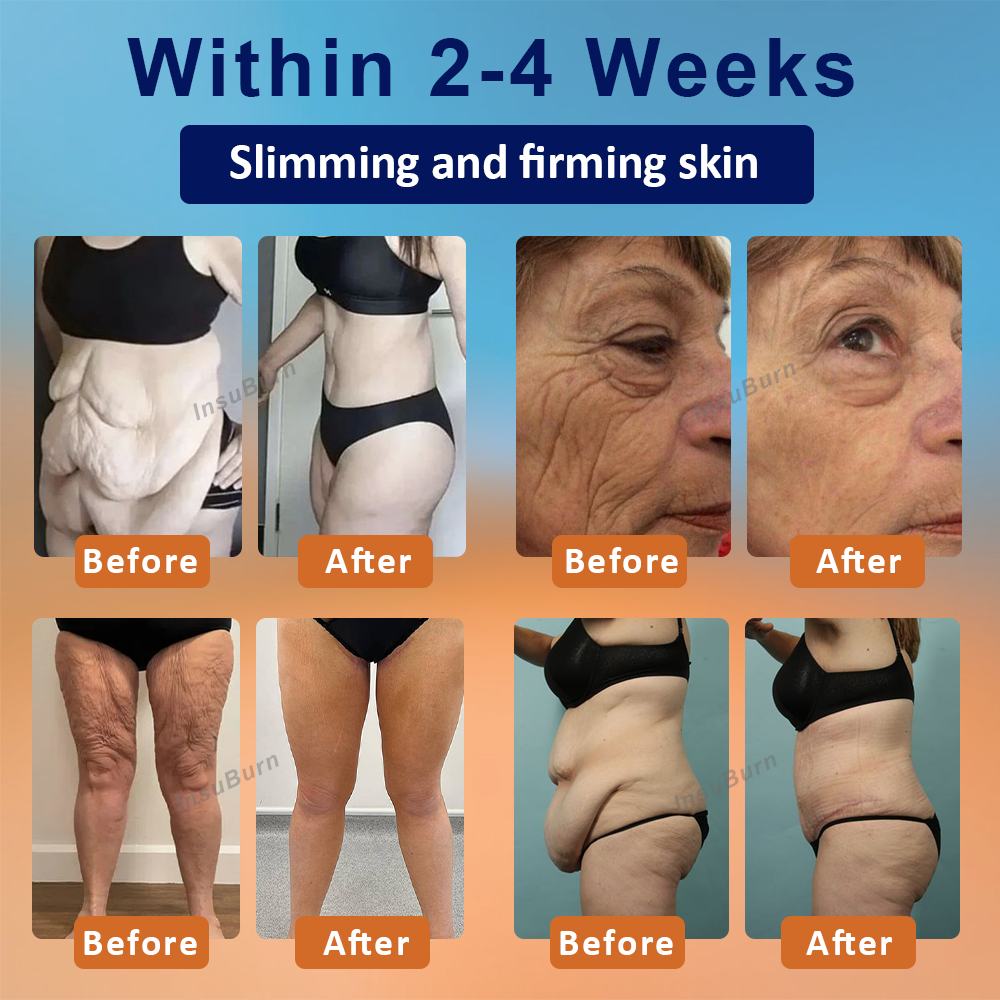 InsuBurn™ Fat Regulator BodyCream