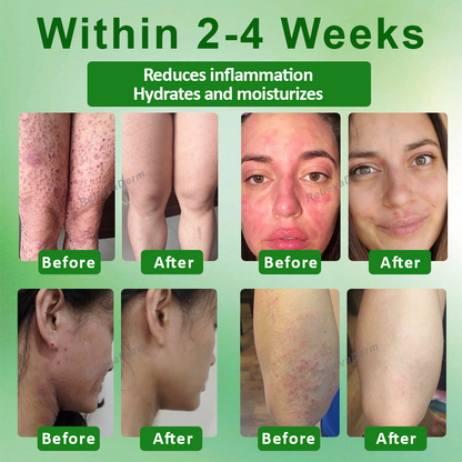 RelievaDerm™ Aloe SkinTherapy  HydratingGel