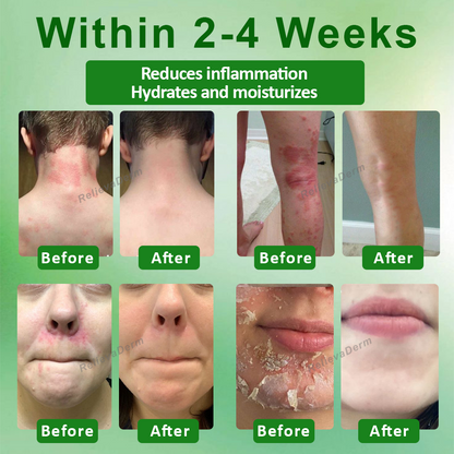 RelievaDerm™ Aloe SkinTherapy  HydratingGel